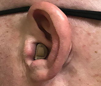 Ear with C.I.C style hearing aid