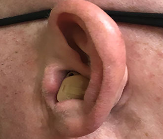 Ear with ITC style hearing aid