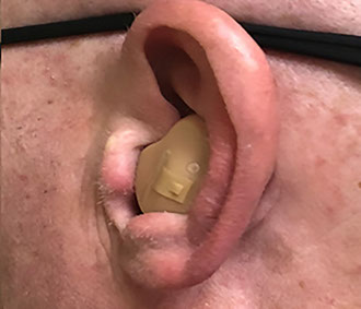Ear with ITE style hearing aid