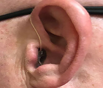 Ear with R.I.C style hearing aid